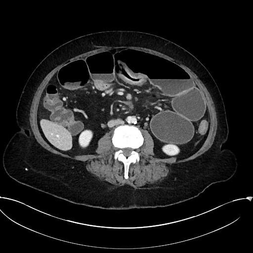 Active Crohn disease (Radiopaedia 59394-66750 Axial C+ portal venous phase 39).jpg
