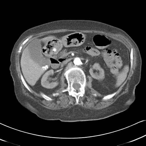 Active bleeding from duodenal ulcer with embolization (Radiopaedia 34216-35481 Axial C+ arterial phase 23).png