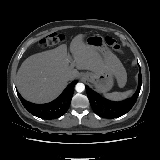 Active colonic bleed on CT (Radiopaedia 49765-55025 Axial C+ arterial phase 16).jpg