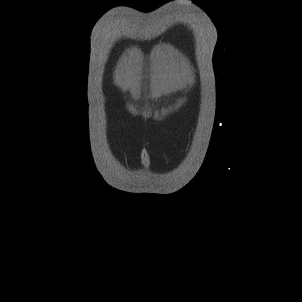 Active colonic bleed on CT (Radiopaedia 49765-55025 Coronal art MIP 7).jpg
