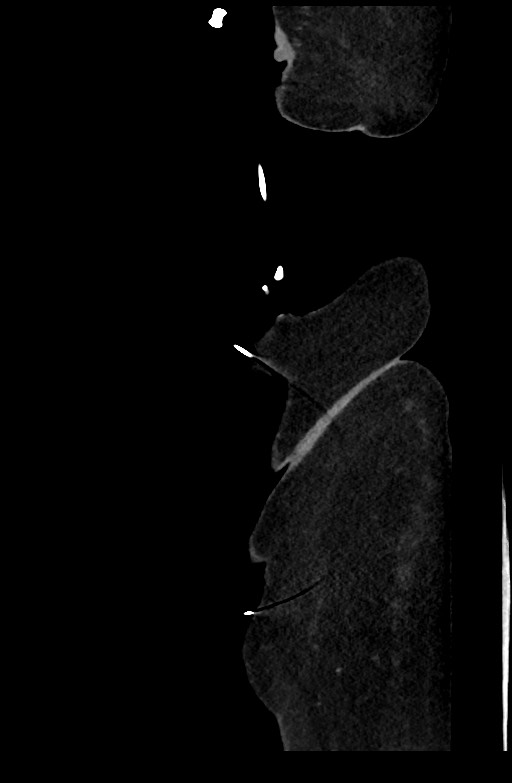 Active renal extravasation with large subcapsular and retroperitoneal hemorrhage (Radiopaedia 60975-68796 Sagittal C+ portal venous phase 19).jpg