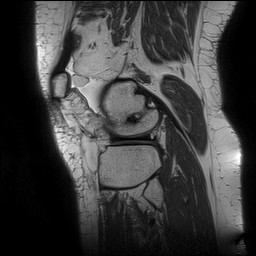 File:Acute-on-chronic transient lateral patellar dislocation with trochlear dysplasia (Radiopaedia 84099-99349 Sagittal PD 126).jpg