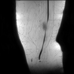 Acute-on-chronic transient lateral patellar dislocation with trochlear dysplasia (Radiopaedia 84099-99349 Sagittal PD 4).jpg
