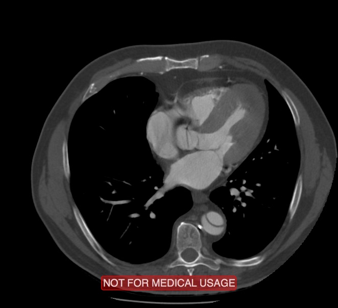 Acute aortic dissection - Stanford type A (Radiopaedia 40661-43285 Axial C+ arterial phase 44).jpg