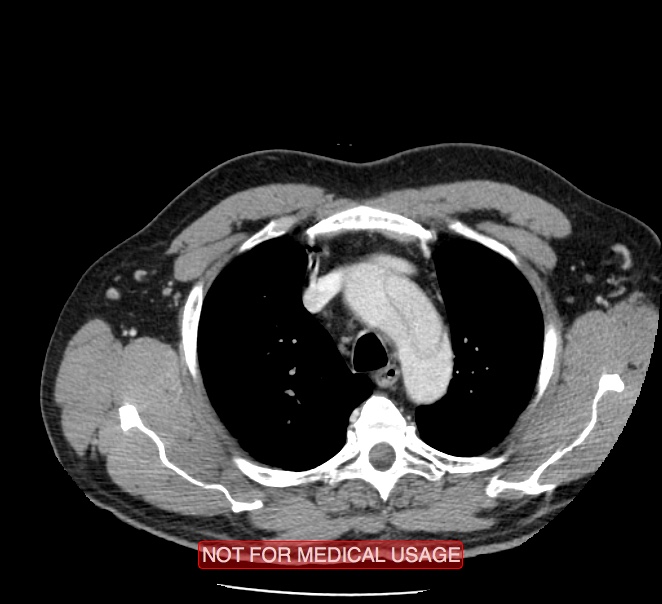 Acute aortic dissection - Stanford type A (Radiopaedia 40661-43285 Axial C+ portal venous phase 1).jpg