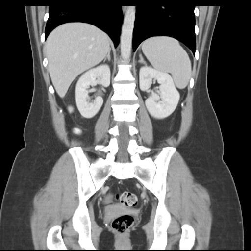 Acute appendicitis (Radiopaedia 30297-30934 Coronal C+ portal venous phase 31).jpg