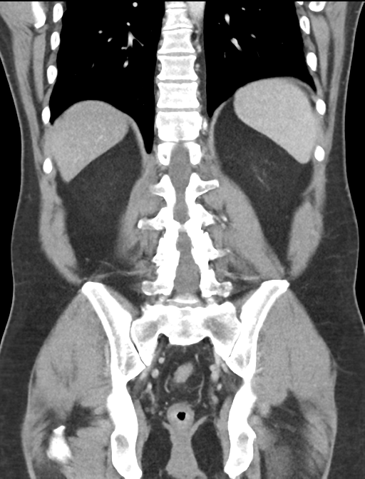 Acute appendicitis (Radiopaedia 36611-38177 Coronal C+ portal venous phase 46).png