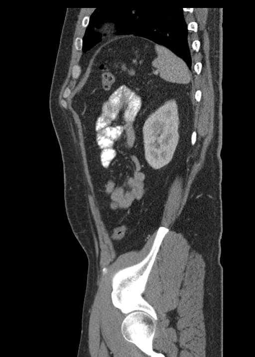 Acute appendicitis (Radiopaedia 48511-53463 Sagittal C+ portal venous phase 104).jpg