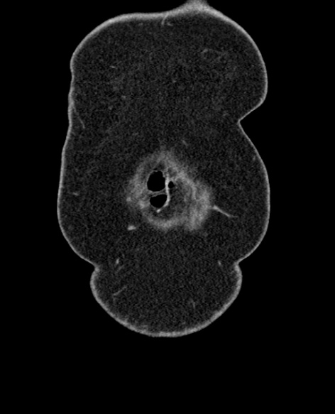 File:Acute appendicitis (Radiopaedia 48792-53822 Coronal C+ portal venous phase 13).jpg