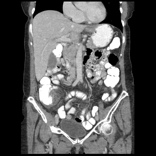 Acute appendicitis (Radiopaedia 52672-58589 Coronal C+ portal venous phase 39).jpg