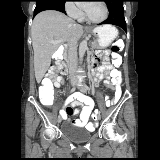 Acute appendicitis (Radiopaedia 52672-58589 Coronal C+ portal venous phase 48).jpg