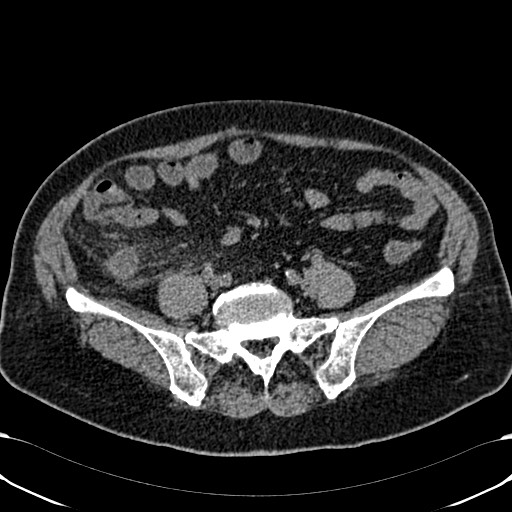 Acute appendicitis (Radiopaedia 58627-65818 Axial non-contrast 61).jpg