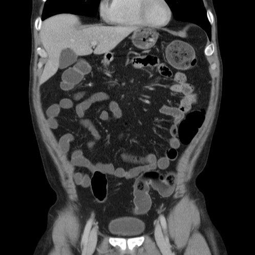 Acute appendicitis (Radiopaedia 66513-75790 Coronal C+ portal venous phase 17).jpg