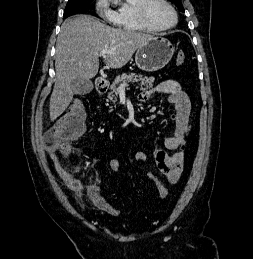 Acute appendicitis (Radiopaedia 79950-93224 Coronal C+ portal venous phase 31).jpg