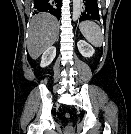 Acute appendicitis (Radiopaedia 79950-93224 Coronal C+ portal venous phase 67).jpg