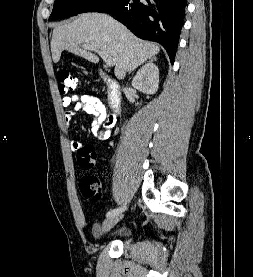 Acute appendicitis (Radiopaedia 84780-100240 Sagittal C+ portal venous phase 37).jpg