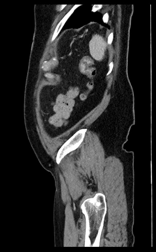 Acute appendicitis - large appendicoliths (Radiopaedia 61805-69820 Sagittal C+ portal venous phase 12).jpg