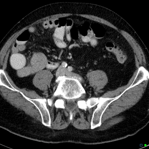 File:Acute appendicitis arising from a malrotated cecum (Radiopaedia 19970-19997 Axial C+ portal venous phase 27).jpg