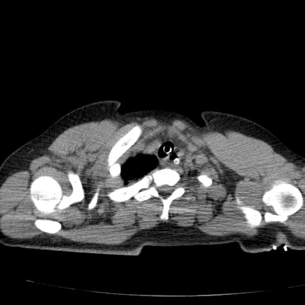 Acute aspiration pneumonitis (Radiopaedia 33605-34703 Axial non-contrast 19).jpg