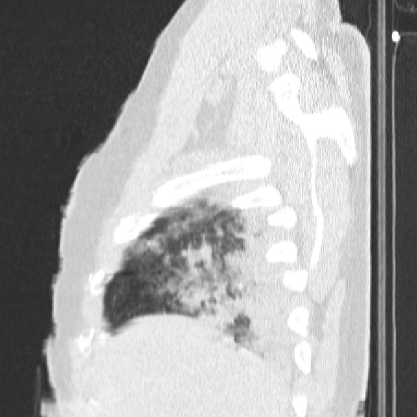 Acute aspiration pneumonitis (Radiopaedia 33605-34703 Sagittal lung window 15).jpg