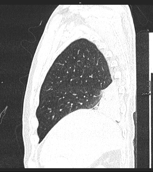Acute aspiration pneumonitis (Radiopaedia 55642-62166 Sagittal lung window 126).jpg