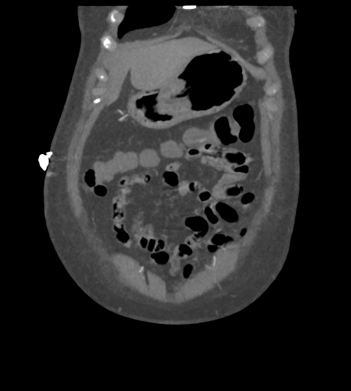 File:Acute bleed from gastric fundus biopsy site (Radiopaedia 35201-36737 Coronal C+ arterial phase 13).png