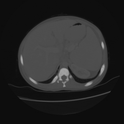 File:Acute calculous cholecystitis in patient with osteopetrosis (Radiopaedia 77871-90159 Axial bone window 12).jpg