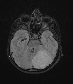 File:Acute cerebellar ataxia (Radiopaedia 61487-69446 Axial FLAIR 6).jpg