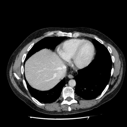 Acute cholecystitis and incidental left sided IVC (Radiopaedia 49352-54459 Axial C+ portal venous phase 24).jpg