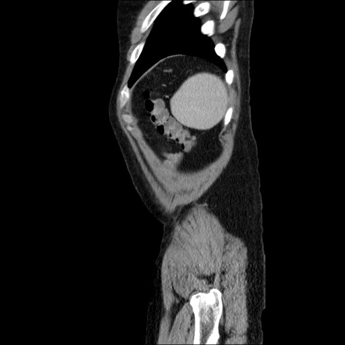 Acute cholecystitis and incidental left sided IVC (Radiopaedia 49352-54459 Sagittal C+ portal venous phase 14).jpg
