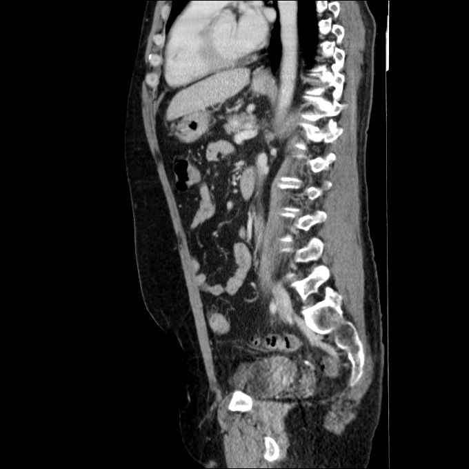 Acute cholecystitis and incidental left sided IVC (Radiopaedia 49352-54459 Sagittal C+ portal venous phase 40).jpg