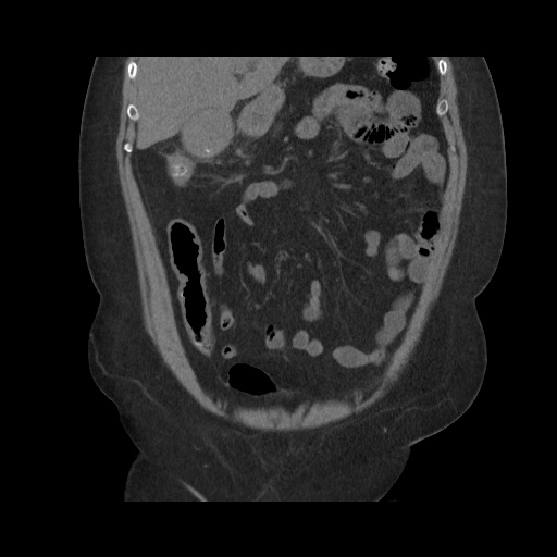 File:Acute cholecystitis with tensile fundus sign (Radiopaedia 71394-81723 Coronal non-contrast 49).jpg