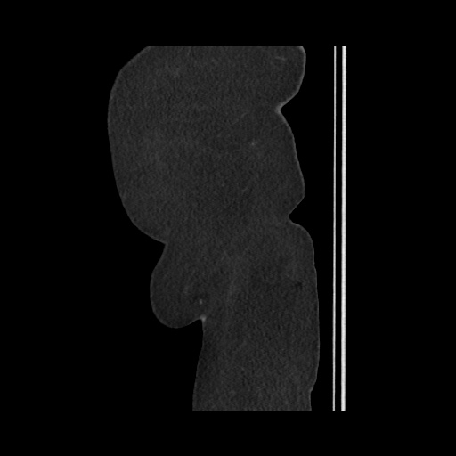 File:Acute cholecystitis with tensile fundus sign (Radiopaedia 71394-81723 Sagittal non-contrast 160).jpg