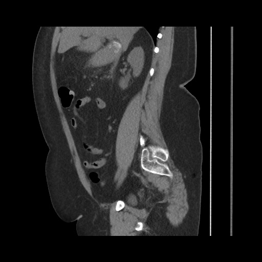 Acute cholecystitis with tensile fundus sign (Radiopaedia 71394-81723 Sagittal non-contrast 72).jpg