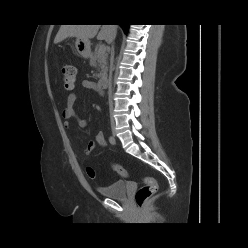 Acute cholecystitis with tensile fundus sign (Radiopaedia 71394-81723 Sagittal non-contrast 85).jpg