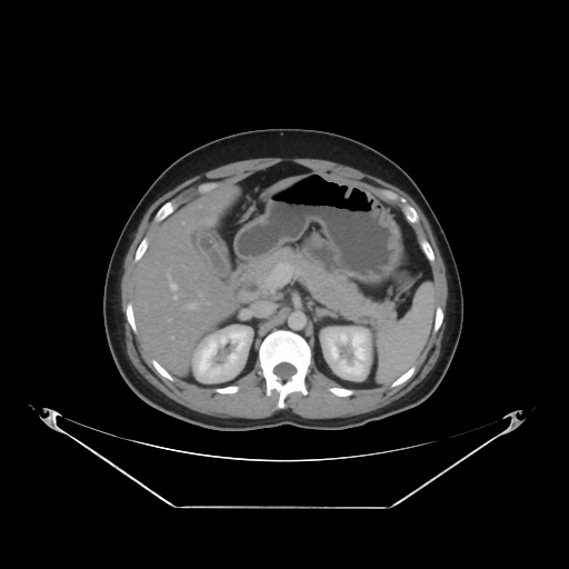 File:Acute complicated calculous cholecystitis (Radiopaedia 55202-61587 Axial C+ delayed 35).jpg