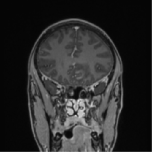 File:Acute disseminated encephalomyelitis (ADEM) (Radiopaedia 65319-74349 Coronal T1 C+ 42).png