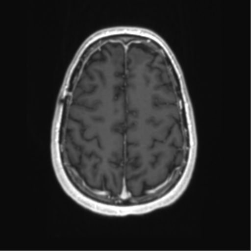 Acute disseminated encephalomyelitis (ADEM) (Radiopaedia 65319-74350 Axial T1 C+ 50).png
