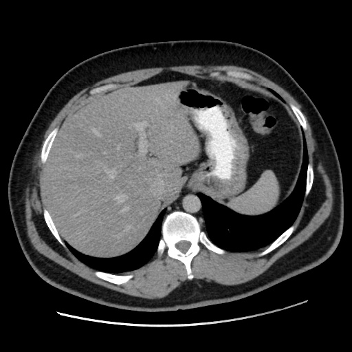 Acute diverticulitis with localized perforation (Radiopaedia 41296-44113 Axial C+ portal venous phase 19).jpg
