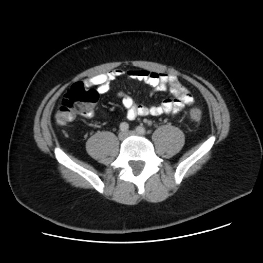 File:Acute diverticulitis with localized perforation (Radiopaedia 41296-44113 Axial C+ portal venous phase 60).jpg