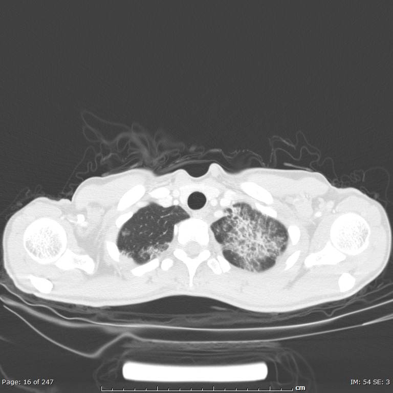 Acute eosinophilic pneumonia (Radiopaedia 48211-53073 Axial lung window 6).jpg