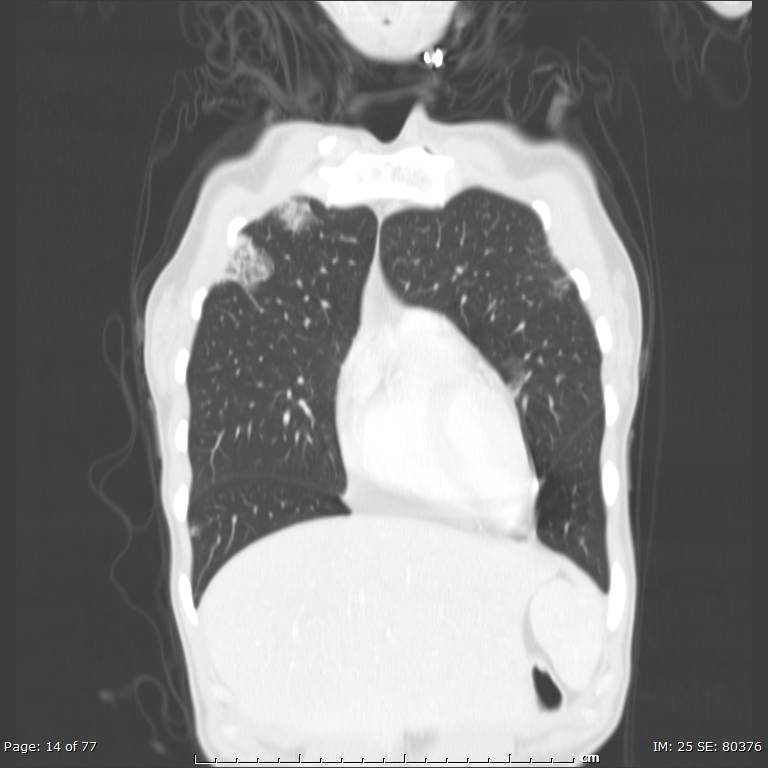 Acute eosinophilic pneumonia (Radiopaedia 48211-53073 Coronal lung window 8).jpg