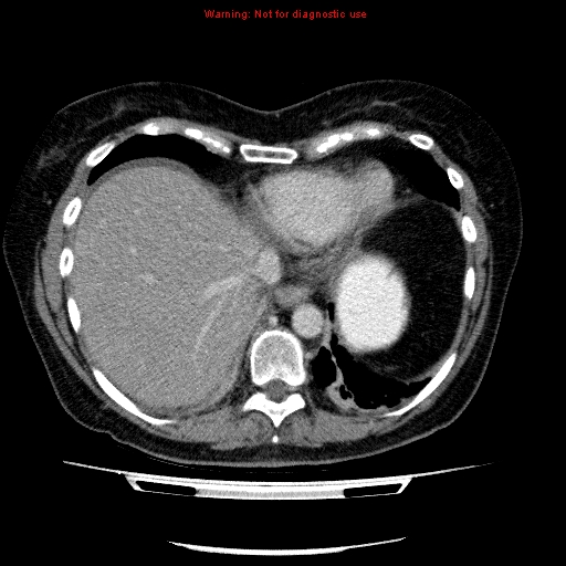 Acute gangrenous cholecystitis (Radiopaedia 10123-10661 Axial C+ portal venous phase 12).jpg