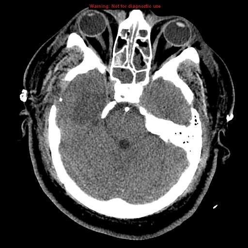 File:Acute hemorrhagic leukoencephalitis (Radiopaedia 14076-43697 Axial non-contrast 14).jpg