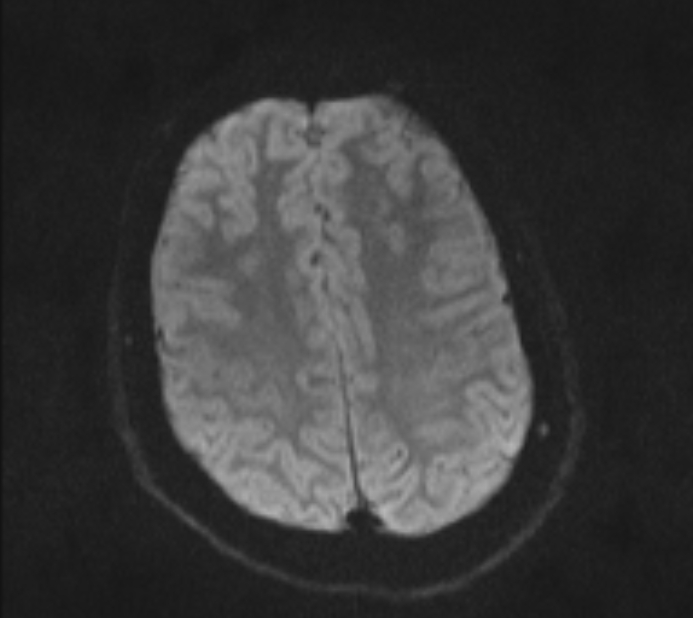 Acute ischemic stroke - posterior circulation territory (Radiopaedia 77670-89880 Axial DWI 41).jpg