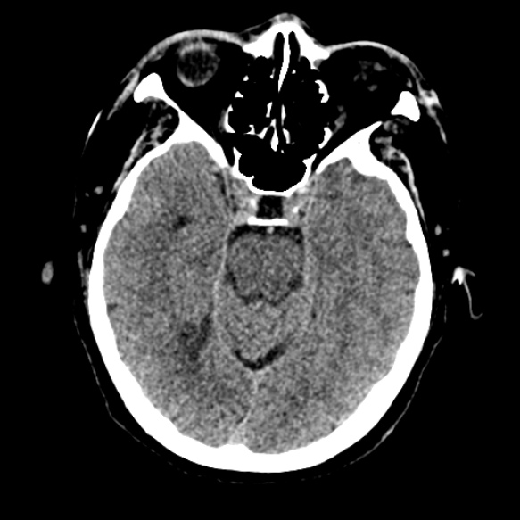 Acute middle cerebral artery territory infarct (Radiopaedia 52380-58283 Axial non-contrast 34).jpg