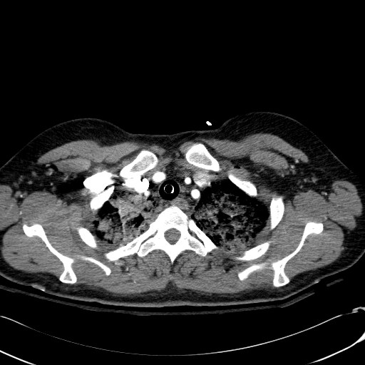File:Acute myocardial infarction in CT (Radiopaedia 39947-42415 Axial C+ arterial phase 20).jpg