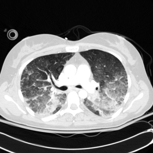 Acute myocardial infarction in CT (Radiopaedia 39947-42415 Axial lung window 51).jpg