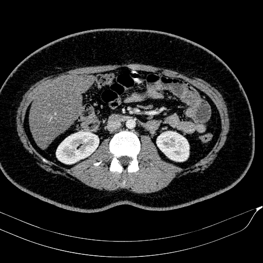 Acute on chronic pancreatitis (Radiopaedia 80902-94423 Axial C+ portal venous phase 90).jpg