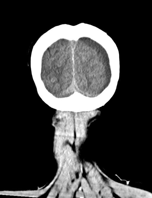 Acute on chronic subdural hematoma (Radiopaedia 74814-85823 Coronal non-contrast 59).jpg
